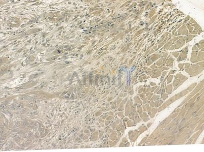 Phospho-RYR2 (Ser2814) Antibody - AF2303 at 1/100 staining human tongue carcinoma by IHC-P.
