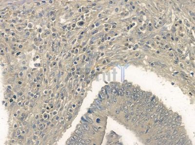 Phospho-RYR3 (Ser160) Antibody - AF2304 at 1/100 staining human colon carcinoma by IHC-P.