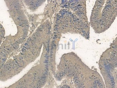 Phospho-RYR3 (Ser160) Antibody - AF2304 at 1/100 staining human colon carcinoma by IHC-P.