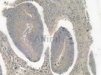 Phospho-Connexin 43 / GJA1 (Ser262) Antibody - AF2307 at 1/100 staining human colon carcinoma by IHC-P.
