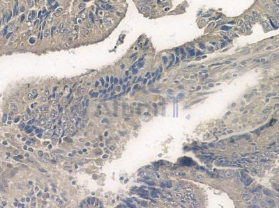 Phospho-Bim (Ser77) Antibody - AF2325 at 1/100 staining human colon carcinoma by IHC-P.