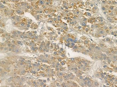 Phospho-CaMKII (Tyr231) Antibody - AF2327 at 1/100 staining human hepatocellular carcinoma by IHC-P.