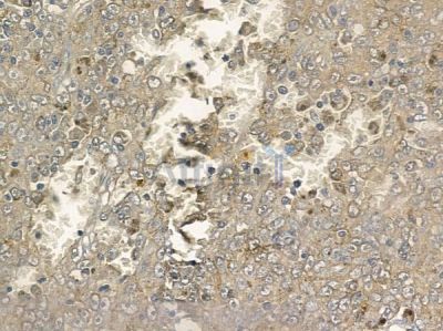 Phospho-CBL (Tyr700) Antibody - AF2328 at 1/100 staining human melanoma by IHC-P.