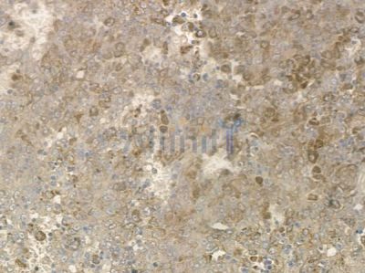 Phospho-DDR1 (Tyr513) Antibody - AF2337 at 1/100 staining human melanoma by IHC-P.