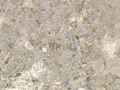 Phospho-eIF4G1 (Ser1147) Antibody - AF2341 at 1/100 staining human lung squamous cell carcinoma by IHC-P.