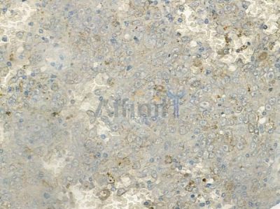 Phospho-HER2/ErbB2 (Tyr1221/Tyr1222) Antibody - AF2349 at 1/100 staining human melanoma by IHC-P.