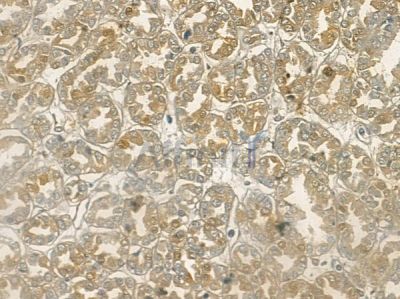 Phospho-MST1(Thr183)/MST2(Thr180) Antibody - AF2367 at 1/100 staining human renal cell carcinoma by IHC-P.