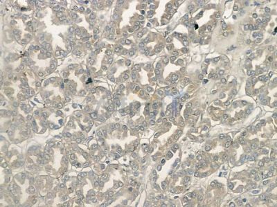 Phospho-Myt1 (Ser83) Antibody - AF2369 at 1/100 staining human renal cell carcinoma by IHC-P.