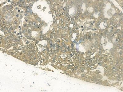 Phospho-NEDD4L (Ser448) Antibody - AF2370 at 1/100 staining human ovarian carcinoma by IHC-P.