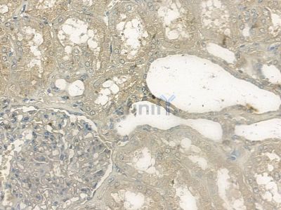 Phospho-p40 phox (Thr154) Antibody - AF2376 at 1/100 staining human pancreatic cancer by IHC-P.