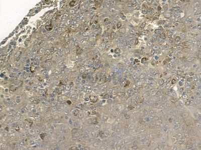 Phospho-p53 (Thr18) Antibody - AF2377 at 1/100 staining human liver cancer by IHC-P.