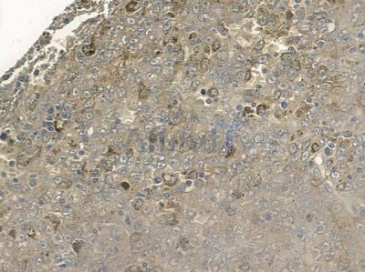 Phospho-p53 (Thr18) Antibody - AF2377 at 1/100 staining human melanoma by IHC-P.