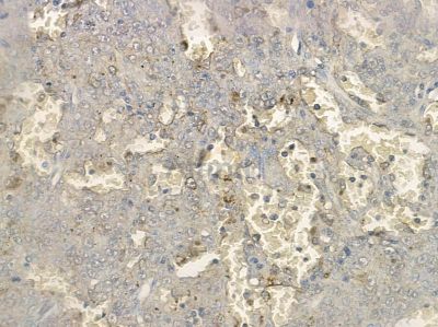 Phospho-p53 (Thr81) Antibody - AF2378 at 1/100 staining human liver cancer by IHC-P.