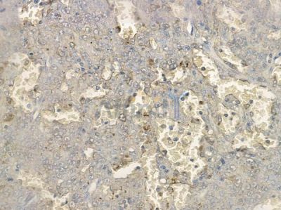 Phospho-p53 (Thr81) Antibody - AF2378 at 1/100 staining human melanoma by IHC-P.