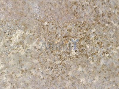 Phospho-PBK/TOPK (Thr9) Antibody - AF2382 at 1/100 staining human melanoma by IHC-P.