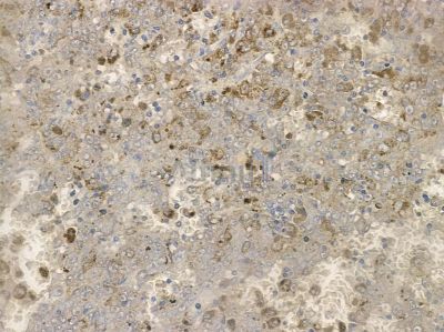 Phospho-PLCG2 (Tyr1217) Antibody - AF2384 at 1/100 staining human liver cancer by IHC-P.