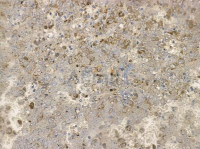 Phospho-PLCG2 (Tyr1217) Antibody - AF2384 at 1/100 staining human melanoma by IHC-P.
