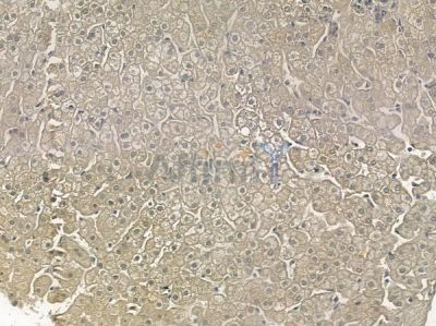 Phospho-PLK1 (Thr210) Antibody - AF2385 at 1/100 staining human hepatocellular carcinoma by IHC-P.