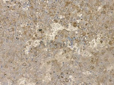 Phospho-PRAS40 (Ser183) Antibody - AF2386 at 1/100 staining human melanoma by IHC-P.