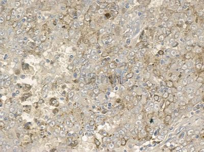 Phospho-PSD93 (Tyr340) Antibody - AF2389 at 1/100 staining human liver cancer by IHC-P.