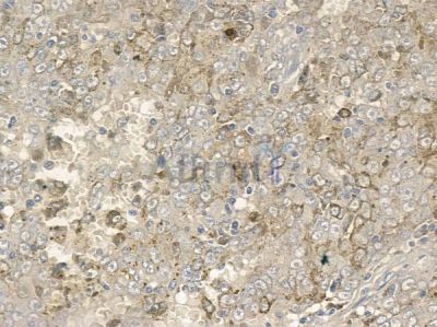 Phospho-PSD93 (Tyr340) Antibody - AF2389 at 1/100 staining human melanoma by IHC-P.