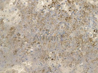 Phospho-PSD95 (Ser295) Antibody - AF2390 at 1/100 staining human melanoma by IHC-P.