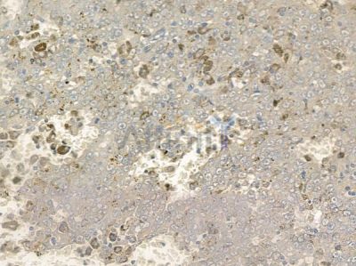 Phospho-PTP  alpha (Tyr798) Antibody - AF2392 at 1/100 staining human melanoma by IHC-P.
