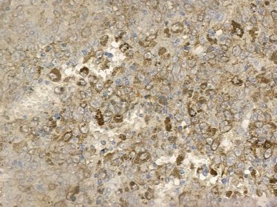 Phospho-Rac1/cdc42 (Ser71) Antibody - AF2393 at 1/100 staining human liver cancer by IHC-P.