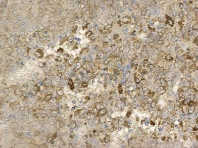 Phospho-Rac1/cdc42 (Ser71) Antibody - AF2393 at 1/100 staining human melanoma by IHC-P.