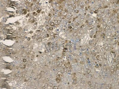 Phospho-REPS1 (Ser709) Antibody - AF2396 at 1/100 staining human melanoma by IHC-P.