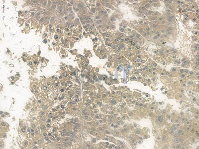 Phospho-Rictor (Thr1135) Antibody - AF2397 at 1/100 staining human hepatocellular carcinoma by IHC-P.