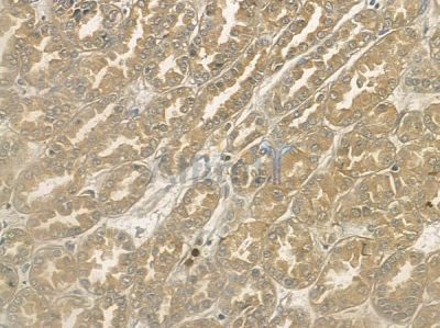 Phospho-RIPK1 (Ser166) Antibody - AF2398 at 1/100 staining human renal cell carcinoma by IHC-P.