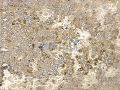 Phospho-RIPK1 (Ser166) Antibody - AF2398 at 1/100 staining human melanoma by IHC-P.
