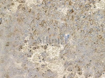 Phospho-Semaphorin 4B (Ser825) Antibody - AF2400 at 1/100 staining human melanoma by IHC-P.