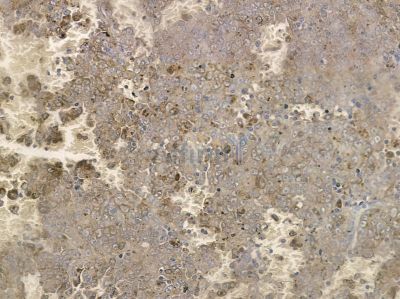 Phospho-SGK3 (Thr320) Antibody - AF2402 at 1/100 staining human liver cancer by IHC-P.