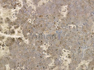 Phospho-SGK3 (Thr320) Antibody - AF2402 at 1/100 staining human melanoma by IHC-P.