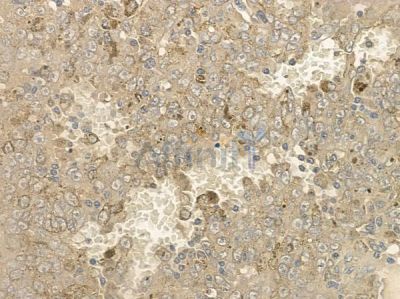 Phospho-SHIP1 (Tyr1020)[Tyr1022] Antibody - AF2403 at 1/100 staining human melanoma by IHC-P.