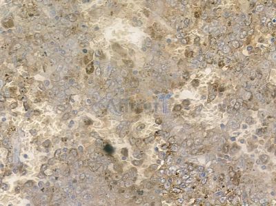 Phospho-Smad1 (Ser206) Antibody - AF2409 at 1/100 staining human liver cancer by IHC-P.