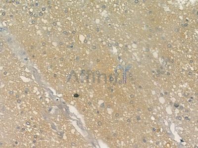 Phospho-SYK (Ser297) Antibody - AF2415 at 1/100 staining human glioblastoma by IHC-P.