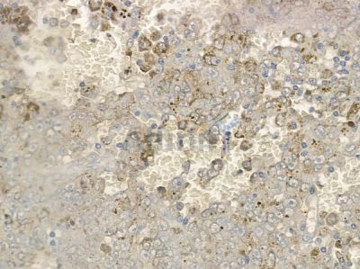 Phospho-TAK1 (Ser439) Antibody - AF2417 at 1/100 staining human melanoma by IHC-P.