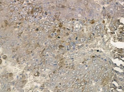 Phospho-TBC1D1 (Thr590) Antibody - AF2422 at 1/100 staining human liver cancer by IHC-P.