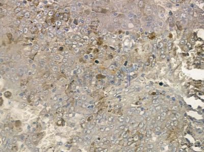 Phospho-TBC1D1 (Thr590) Antibody - AF2422 at 1/100 staining human melanoma by IHC-P.