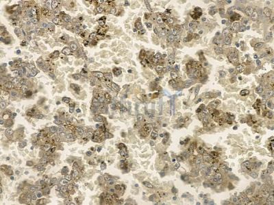 Phospho-TCTP (Ser46) Antibody - AF2423 at 1/100 staining human renal cell carcinoma by IHC-P.