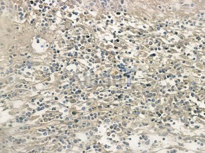 Phospho-TIE2 (Tyr992) Antibody - AF2424 at 1/100 staining human cervical carcinoma by IHC-P.