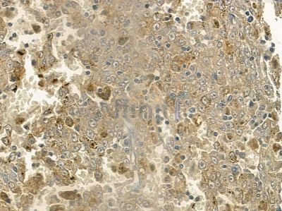 Phospho-TIE2 (Tyr992) Antibody - AF2424 at 1/100 staining human melanoma by IHC-P.