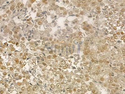 Phospho-TRAF2 (Ser11) Antibody - AF2428 at 1/100 staining human prostate carcinoma by IHC-P.