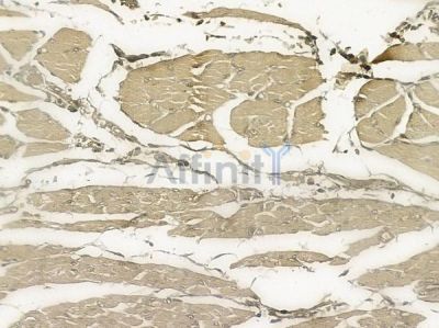 Phospho-TrkA (Tyr490) Antibody - AF2429 at 1/100 staining human tongue carcinoma by IHC-P.