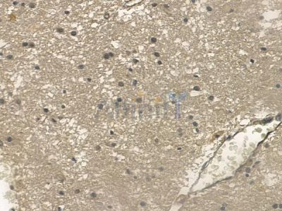 Phospho-ULK1 (Ser467) Antibody - AF2432 at 1/100 staining human glioblastoma by IHC-P.