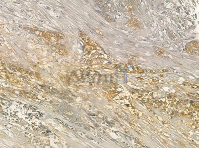 Phospho-WIPI2 (Ser413) Antibody - AF2434 at 1/100 staining human breast carcinoma by IHC-P.
