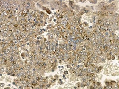 Phospho-Calnexin (Ser564) Antibody - AF2438 at 1/100 staining human melanoma by IHC-P.